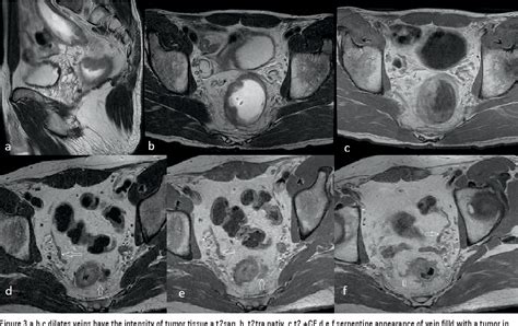 Figure 1 from MRI Evaluation of Extramural Venous Invasion (EMVI) with ...