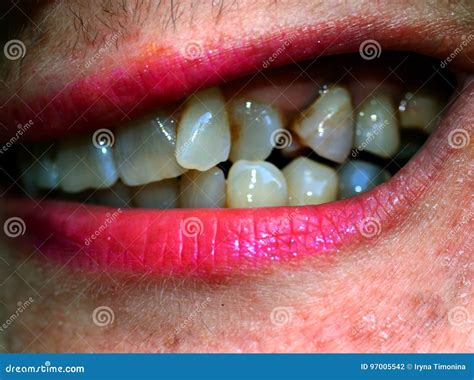 Crooked Teeth Before Braces Royalty-Free Stock Photography ...