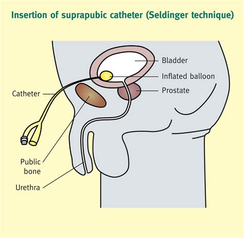 Surgical complications of paralysis - Surgery - Oxford International Edition