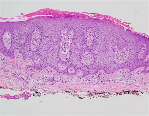 Clear Cell Acanthoma Histology