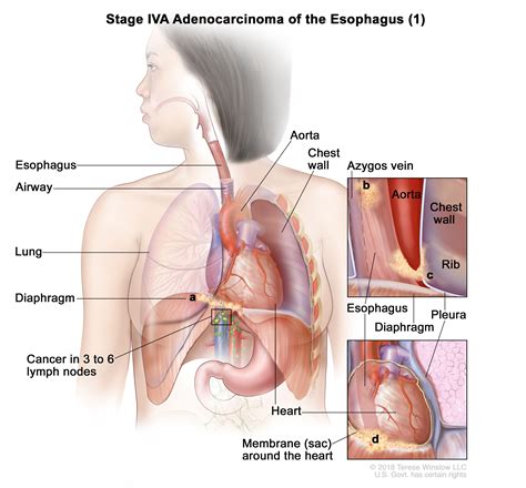 Esophageal Cancer | Vanderbilt-Ingram Cancer Center