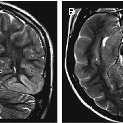 MRI of brain. There is cortical thickening with mildly associated... | Download Scientific Diagram