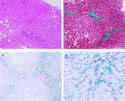 Long-term phlebotomy successfully alleviated hepatic iron accumulation in a ferroportin disease ...