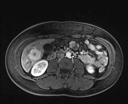 Focal Nodular Hyperplasia Radiology