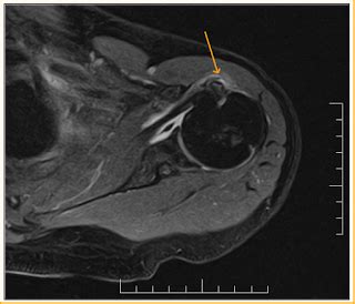 Long Head Biceps Tear-MRI - Radiology Imaging