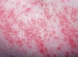 List of Fungal Infection Symptoms