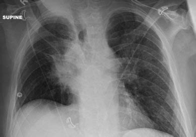 X-ray image showing enlarged hilar lymph nodes. | Download Scientific Diagram