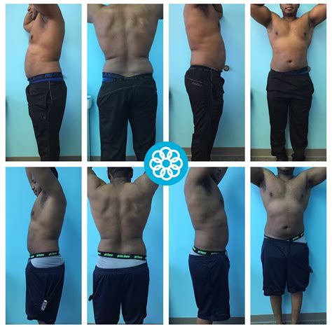 does laser lipo cavitation work - Xavier Rosenthal