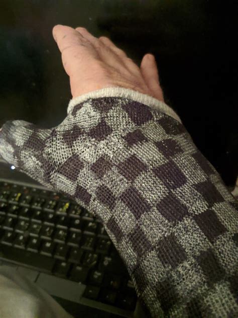 Thumb spica cast scaphoid fracture | Orthopedic cast, It cast, Arm warmers