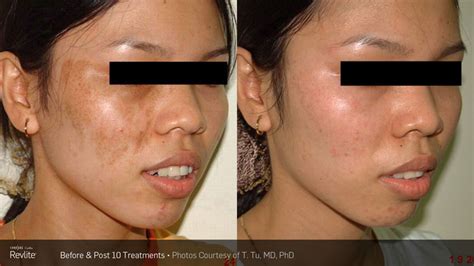 Melasma | Total Body Laser Center Inc