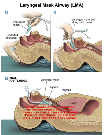 Laryngeal Mask Airway (LMA)