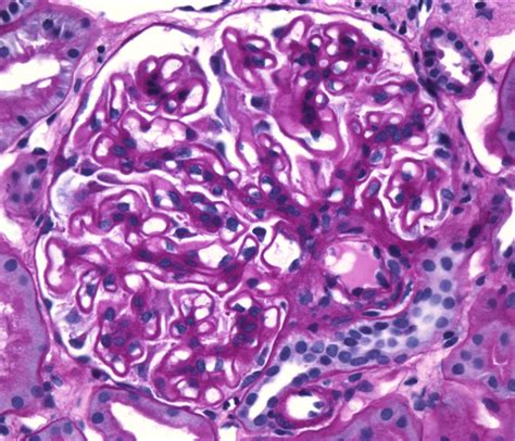 Membranous Nephropathy | BCNephro