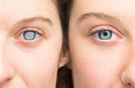 How Does Cataract Surgery Work? | Eye Effects | Calgary