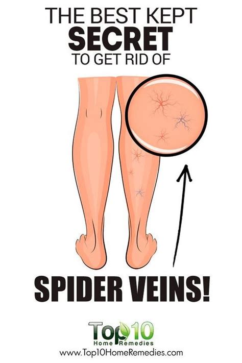 The Best Natural Home Remedies to Get Rid of Spider Veins! | Spider veins, Varicose vein remedy ...