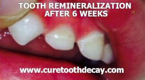 Photographic Proof of Remineralized Cavities - Healthy Home Economist