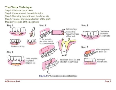 036. mucogingival surgery