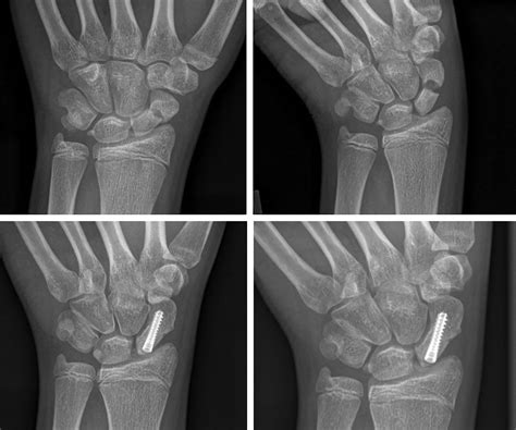 Hand/Finger Fractures - Clinical Tree