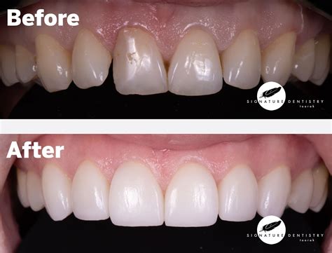 Veneers Before and After By Dr Kasen