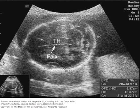 Second Trimester Obstetrical Ultrasound | Basicmedical Key