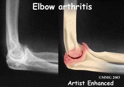 Physical Therapy in Windber for Elbow - Osteoarthritis of the Elbow