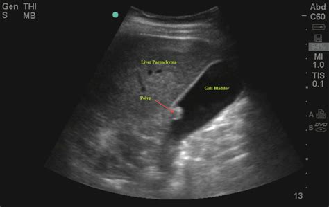 Gallbladder Polyps | Emory School of Medicine