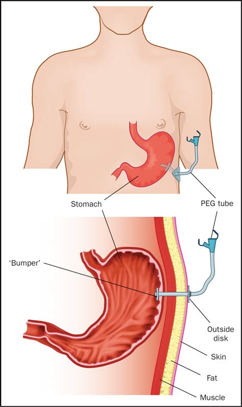 Gastric Feeding Tube