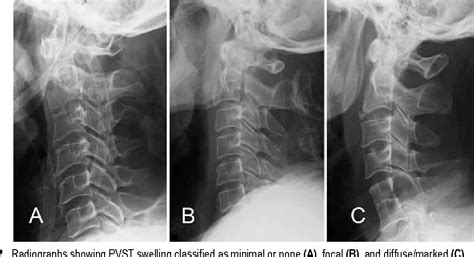 Figure 2 from Clinical features of the extension teardrop fracture of the axis: review of 13 ...