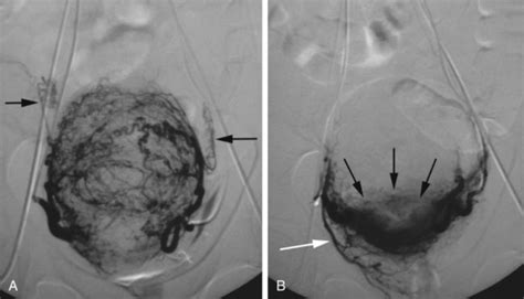 Uterine Fibroid Embolization Ufe Stanford Health Care