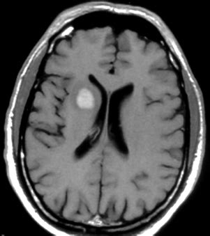 Brain (CNS) Lymphoma