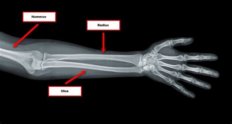 Bones in the Arm - JOI Jacksonville Orthopaedic Institute