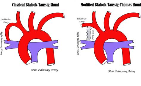 Ultrasound Board Review Modified Blalock Taussig Shunt