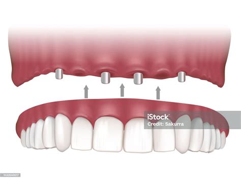 Maxillary Implant Supported Fixed Prosthesis Maxillary Overdentures Supported By Four Implants ...