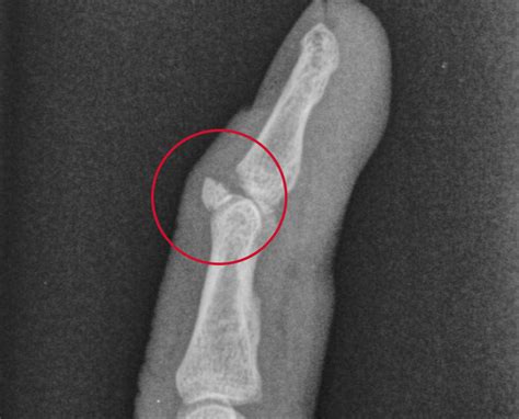 Avulsion Fracture: What It Is, Causes, Symptoms, Treatment & Recovery