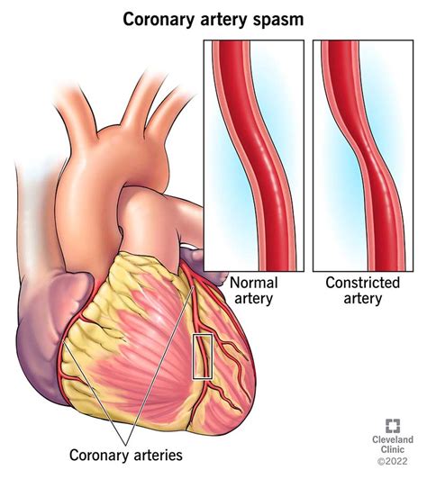 Coronary Artery Spasm: Causes, Symptoms and Treatment