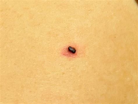 Is this a melanoma? Red ring around suddenly raised & darkened mole : r/skincancer