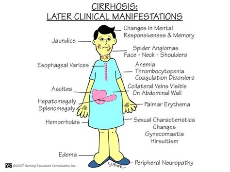 17 Best images about Sclerosis Of The Liver on Pinterest | Fatty liver, For the and It is