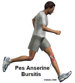 Pes Anserine Bursitis: Causes & Treatment - Knee Pain Explained (2022)