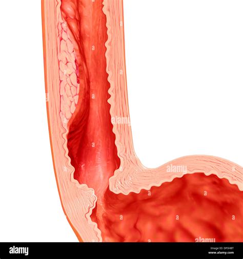 Barrett oesophagus symptoms, artwork Stock Photo - Alamy