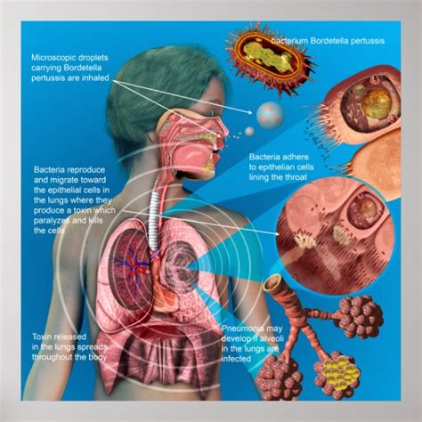 Pertussis (Whooping cough) poster | Zazzle.com