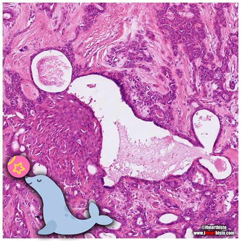 Syringoma Histology