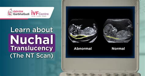 Learn About Nuchal Translucency (The NT Scan)