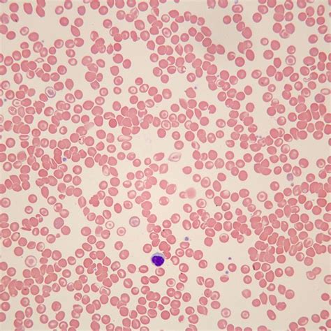 Human Sickle Cell Anemia Slide, Smear, Wright's Stain | Carolina.com