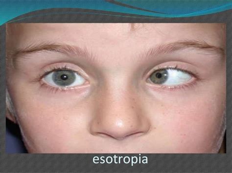 Accommodative esotropia