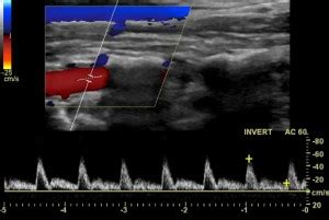 Carotid duplex protocol