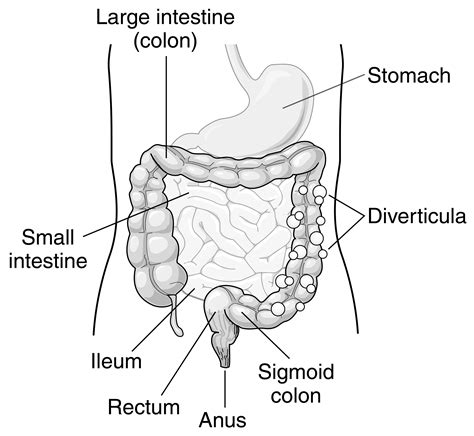 Diverticulosis | Treatments | Patients & Families | UW Health