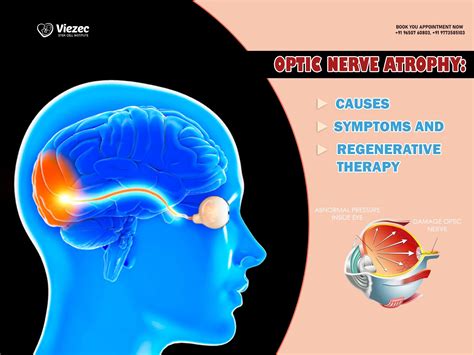 Optic Nerve Atrophy: Causes, Symptoms And Regenerative Therapy