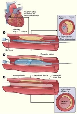 Coronary Angioplasty and Stenting | Cardiac Surgery | Michigan Medicine ...