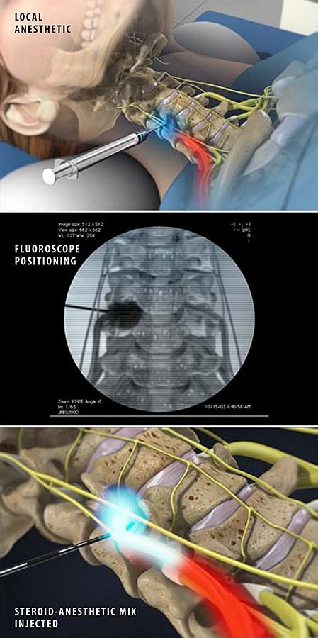 Cervical Transforaminal Epidural Steroid Injection | Central Coast Orthopedic Medical Group