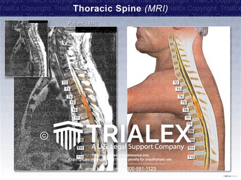 Thoracic Spine (MRI) - TrialExhibits Inc.