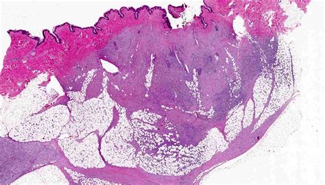 Dermatofibrosarcoma Protuberans Histology